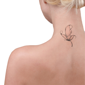 Tattoo Removal Las Vegas NV