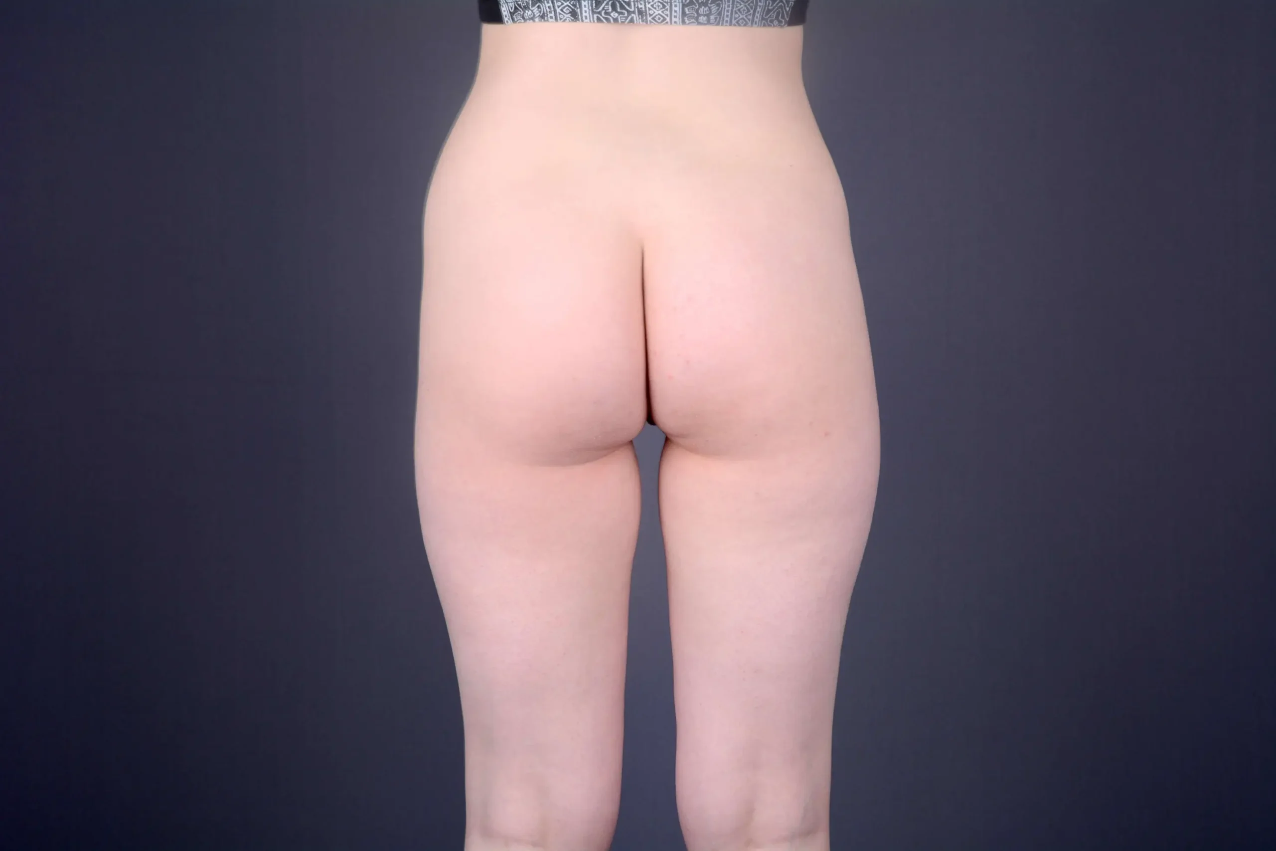 Brazilian butt lift with liposuction Las Vegas NV