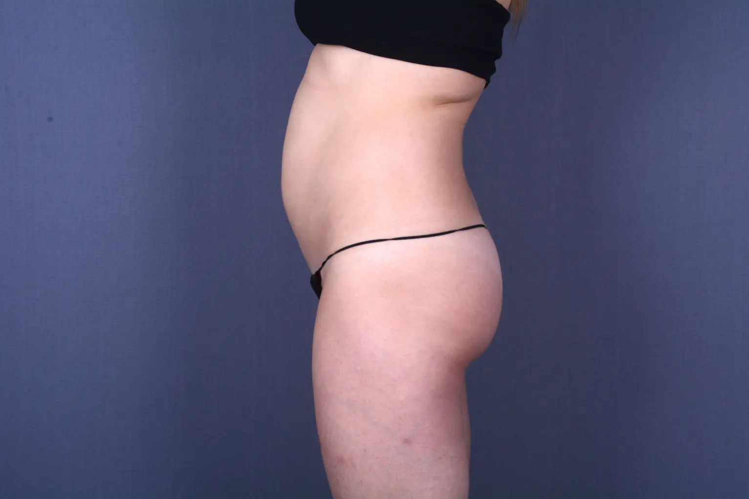 tummy tuck Las Vegas NV