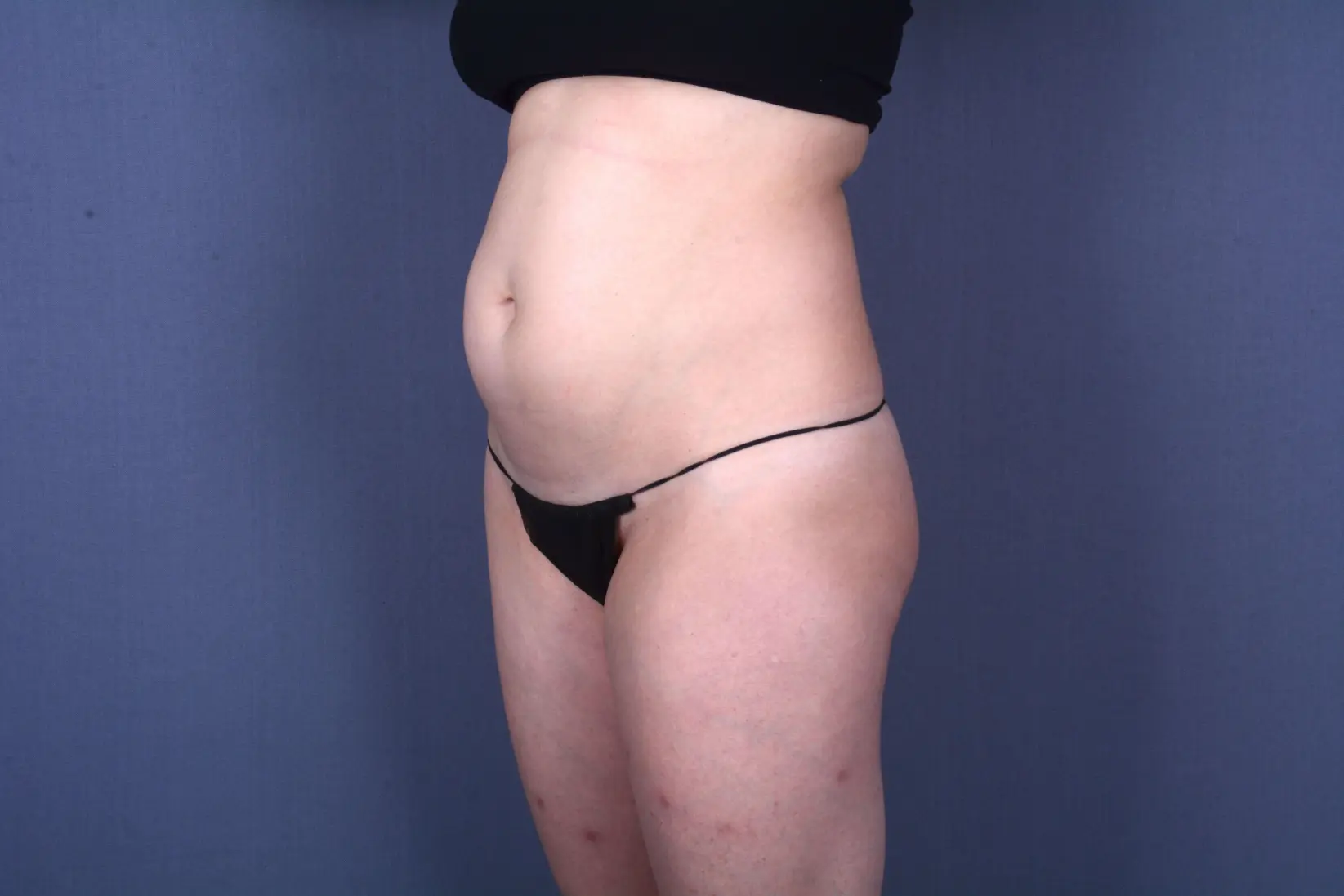 tummy tuck Las Vegas NV