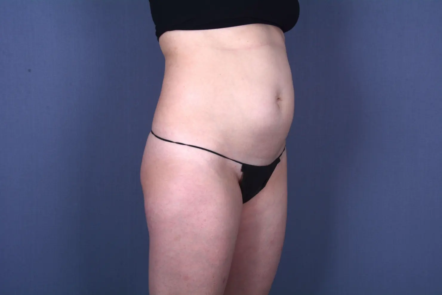 tummy tuck Las Vegas NV